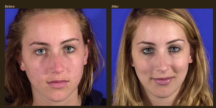 Add Luster To Your Beauty With Rhinoplasty Surgery