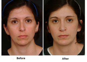 Can Your Nose Grow After Rhinoplasty?