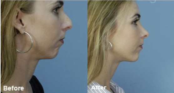 Get The Rhinoplasty Done To Find A New Yourself