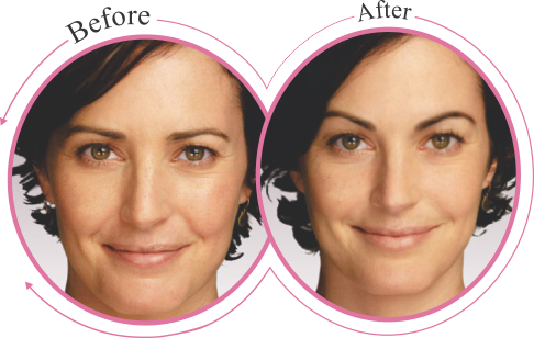 Eye Brow Lift For A More Physically Attractive Facial Appearance